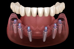 A digital image of an implant-retained denture being placed over the top of 6 dental implants 