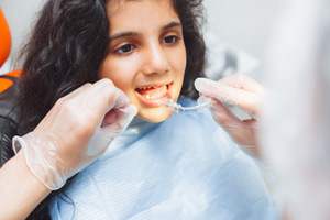 Invisalign teen may be a good fit for your teen if they are responsible for their oral hygiene